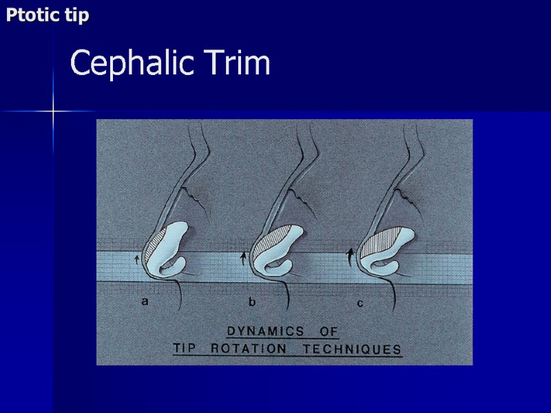 Cephalic Trim Ptotic tip